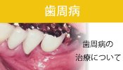 歯周病治療についての詳細